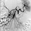 Vascular irregularity and pseudoaneurysm formation