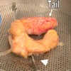 Horseshoe shaped pancreas