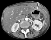 CT scan following PEG-J insertion