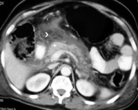 Abdominal CT showing an enhancing pancreas with peripancreatic necrosis