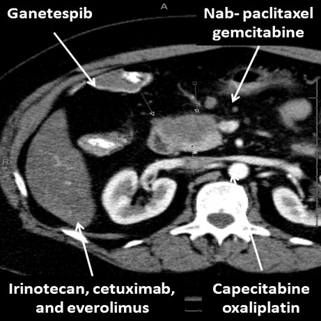 Chemotherapy regimens tested in refractory pancreatic cancer at 2014 ASCO GI Symposium