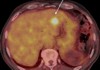 Multiple metastases in the liver