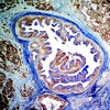 Pancreatic carcinoma stained for Dpc4 suppressor gene