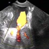 Power Doppler showing vascularity in collection