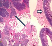 Low power view of the jejunal mass biopsy