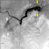 Two large vascular arteriovenous malformations involving both the pancreatic head and tail