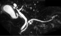 Remarkable change of main pancreatic duct