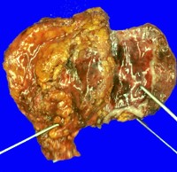 Round and encapsulated fibrotic tumor