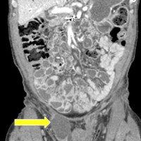 Right-sided inguinal fluid collection at CT scan