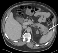 CT image depicting a bulky “soft tissue density” mass of the tail of the pancreas