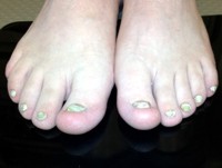 Thick yellow toe nails consistent with ectodermal dysplasia