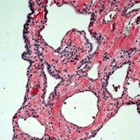 Serous cystadenoma with microcysts lined by bland cuboidal epithelium