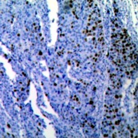 Immunohistochemical staining positive for proliferative marker Ki-67.