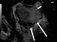 Enlarged pancreas and echoic mass lesion