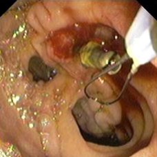 Stent removal after 3 months of follow-up