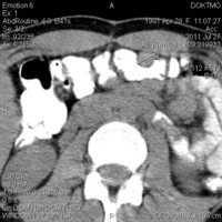 Spiral CT of abdomen and retroperitoneum
