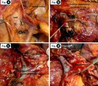 Right posterior approach for pancreaticoduodenectomy