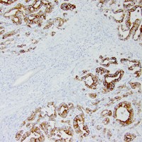 Metastatic papillary gallbladder adenocarcinoma with positive CK20 staining