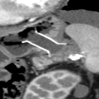 CT abdomen showing stent in-situ