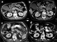 CT of the abdomen showing enlarged pancreas with loss of normal fatty lobulation