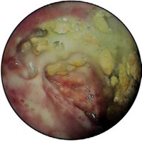 Walled-off pancreatic necrosis interior