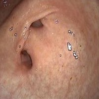 Endoscopic apparence of double pylorus