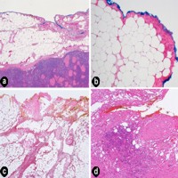 Tissues at the resection margin