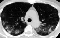 Interstitial lung disease at chest CT