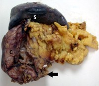 Distal pancreatectomy/splenectomy specimen