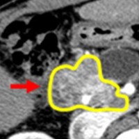 Primary tumor grew after therapy.