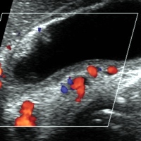 Dilated venous channels in the wall of gallbladder at sonogram