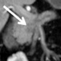 Dilatation of the main pancreatic duct at coronal CT.