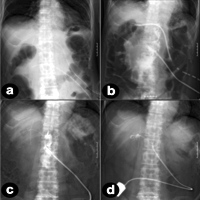 Pancreatic fluid drainage