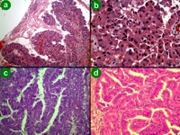 Pathology of intraductal oncocytic papillary neoplasm