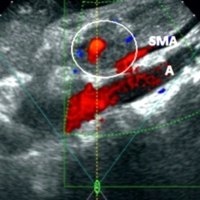 Hyper-echogenic tumor immediately after HIFU ablation