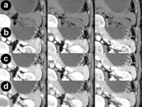 CT scan before and 35, 55, and 80 seconds after the administration of contrast agent