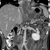 A well-defined rim enhancing pseudocyst