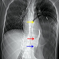 Grossly distended stomach with Ryle’s tube in situ