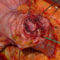 Pancreatic duct reconstruction