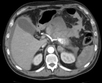 Bleeding pseudoaneurysm at CT with arterial phase