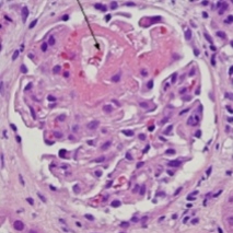 Segmental glomerular necrsosis