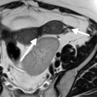 Two horns of bicornuate uterus (arrows) and kidney in pelvis