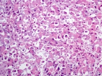 Complete distortion of the pancreatic parenchyma