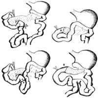 Demolitive and reconstructive phases of pancreaticoduodenectomy