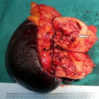 Ossification in the tumor edge