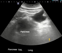 Edematous pancreas and adjacent fluid collection