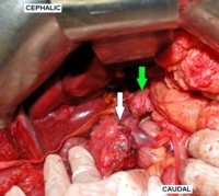 Intraoperative picture demonstrating a SPN in pancreatic head attached to the portal vein