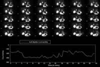 HIDA scan showing a low ejection fraction of the gallbladder after administration of CCK