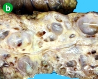 Sectioning of the pancreas demonstrates multiple cysts without any clear communication with the pancreatic duct and no evidence of pancreatic duct dilatation