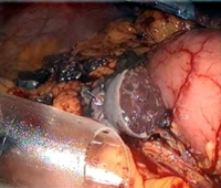 Laparoscopic view after completion of spleen autotransplantation